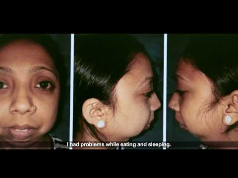 Suman was suffering from a temporomandibular disorder, because of an injury in her childhood. She